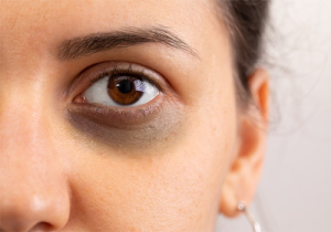 కళ్లకింద నల్లటి వలయాలు ఉన్నాయా.. ఆయుర్వేదం చెప్పిన ఈ మ్యాజిక్ టిప్ ట్రై చేయండి..!